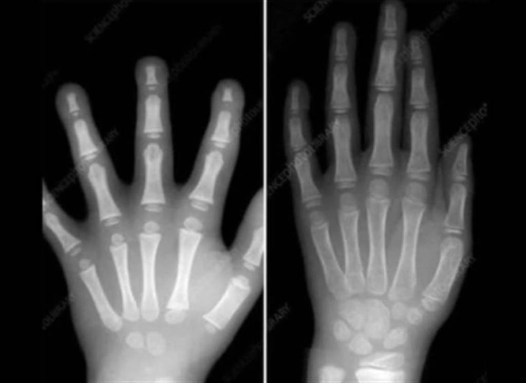 2張手部X光照瘋傳，專家表示，別逼學齡前孩子寫字。（圖／翻攝自靠北醫師）