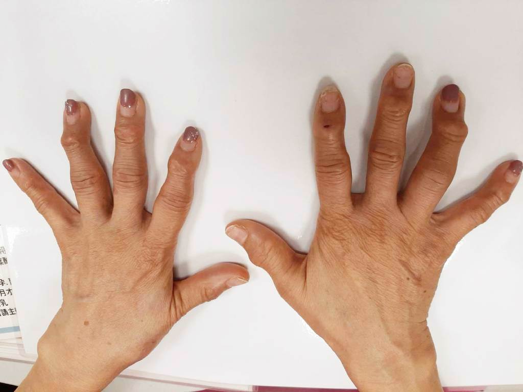手指骨退化性關節炎通常是慢慢產生，常見的症狀為手指關節腫脹，也會感到微痛，初期症狀不明顯，嚴重恐導致手指變形。(圖/恩主公醫院提供)
