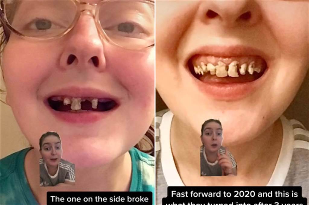 美國一名女子10年來天天喝汽水又不愛刷牙，導致她上排牙齒爛光，必須做假牙。(圖翻攝自紐約郵報)