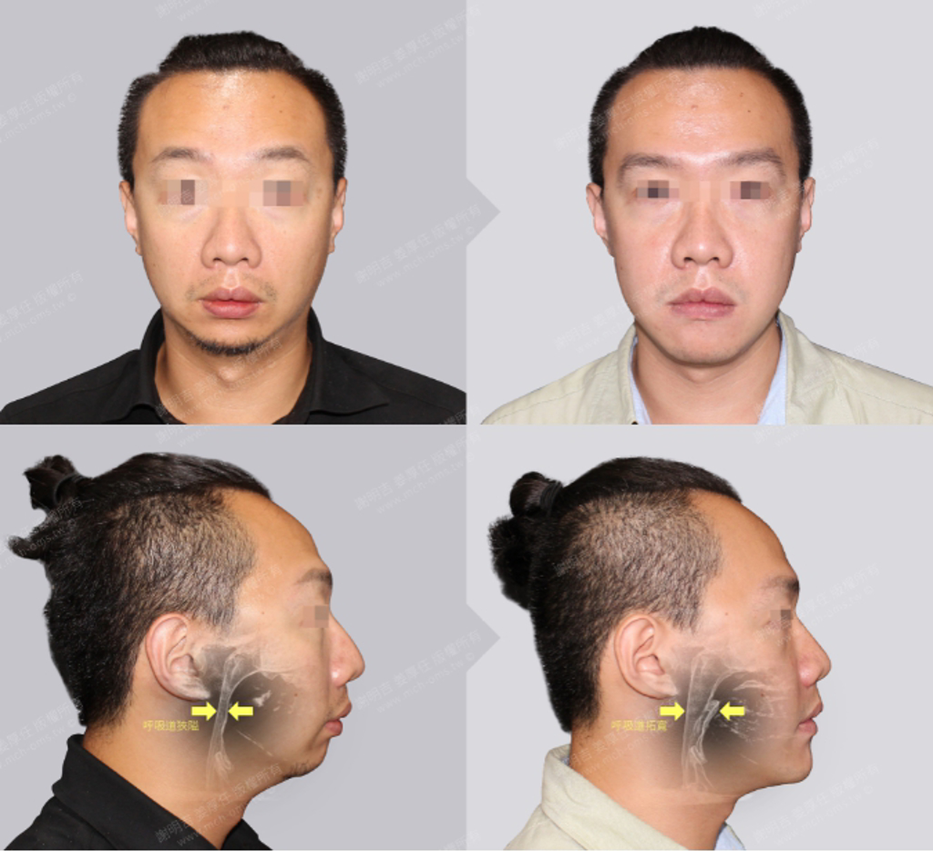 33歲男性患者接受過正顎手術後，不僅拓寬呼吸道，整體臉型的比例也得到平衡。術後AHI指數為3.7。（圖/風華聯合診所提供）