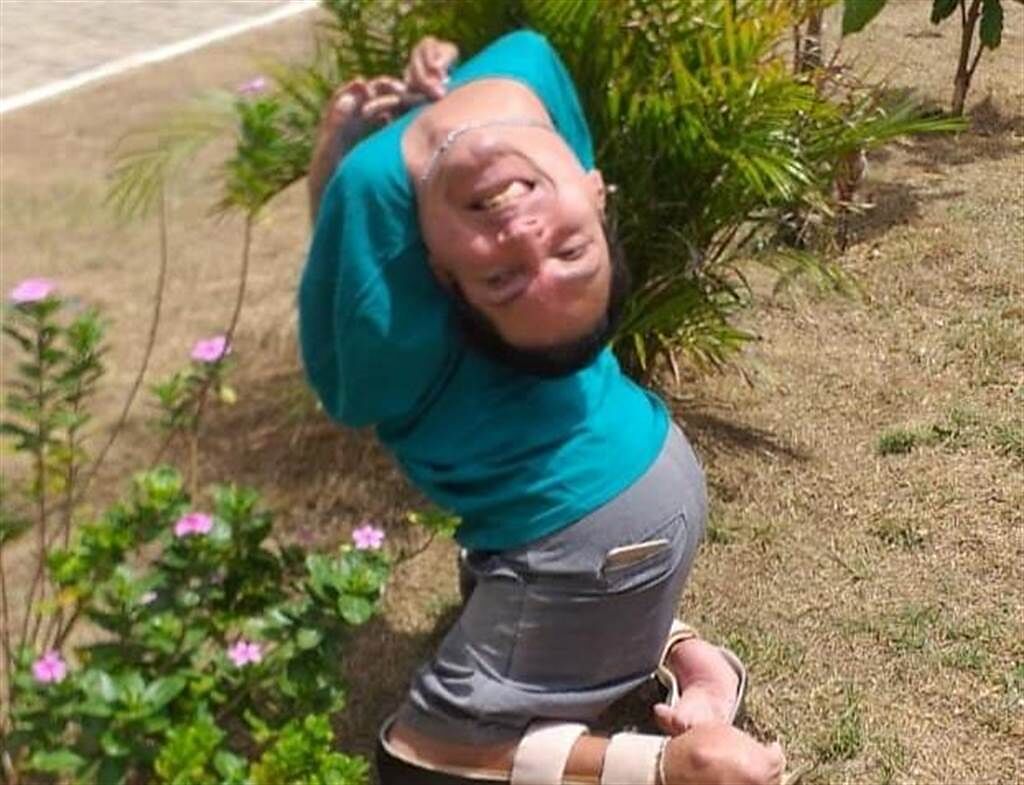 巴西一名男子因罹患「多發性關節炎」，天生頭部接近180度反折，也不能行走。（圖翻攝自Claudio Vieira de Oliveira臉書）