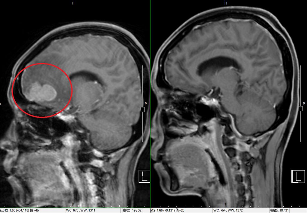 鍾道聲主任表示，以新一代影像導引弧形放射治療腦腫瘤，可降低海馬迴的放射劑量，減少對記憶及認知功能傷害。(圖左為術前，圖右為術後。圖/恩主公醫院提供)
