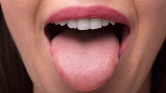 女子患舌癌移植小腿肌膚  痊癒後「嘴裡長毛」超崩潰