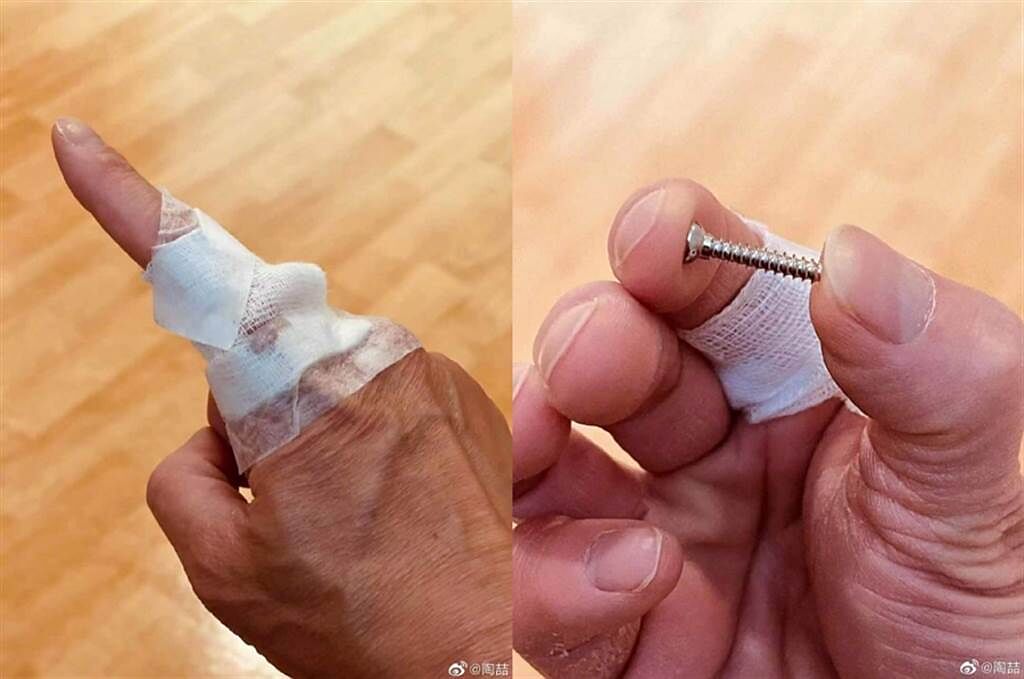 陶喆今日取出放在手指裡15年的鋼釘（螺絲）。(圖/ 摘自陶喆微博)