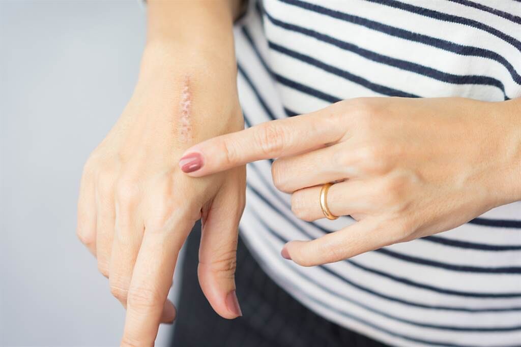 俗稱美容膠帶的免縫膠帶，能促進傷口平整癒合，同時也可對傷口加壓以預防疤痕增生，但須正確使用。(示意圖/Shutterstock)