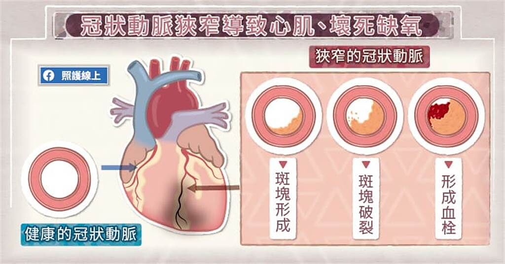 當冠狀動脈有明顯狹窄的狀況，患者只要活動量增加，心肌就會缺氧，導致胸悶不適。(圖/照護線上提供)