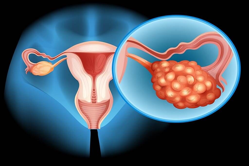 女性重要生殖器官像是子宮、卵巢也在骨盆腔中，當疾病發生時，伴隨的症狀容易被誤解為腸胃問題而遭誤診，延誤治療時機。(示意圖/Shutterstock)