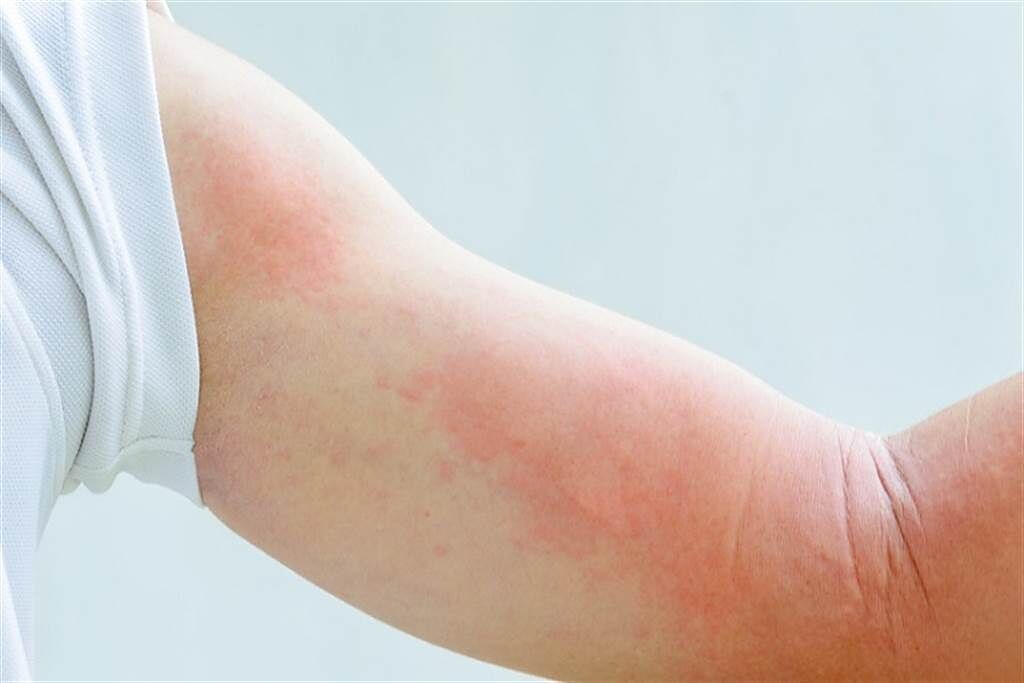 蕁麻疹全身癢爆怎辦？ 皮膚科醫認證「7大止癢攻略」。(圖/常春月刊提供)