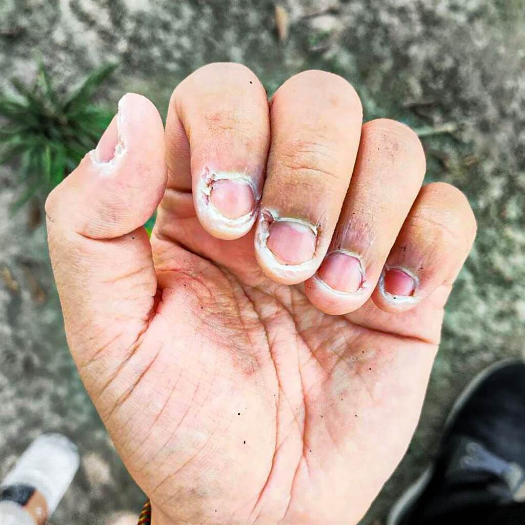屏東縣縣長潘孟安在臉書上分享，醫護人員因為清潔導致雙手乾裂，向其致上最深的感謝與鼓勵。（翻攝自潘孟安臉書）