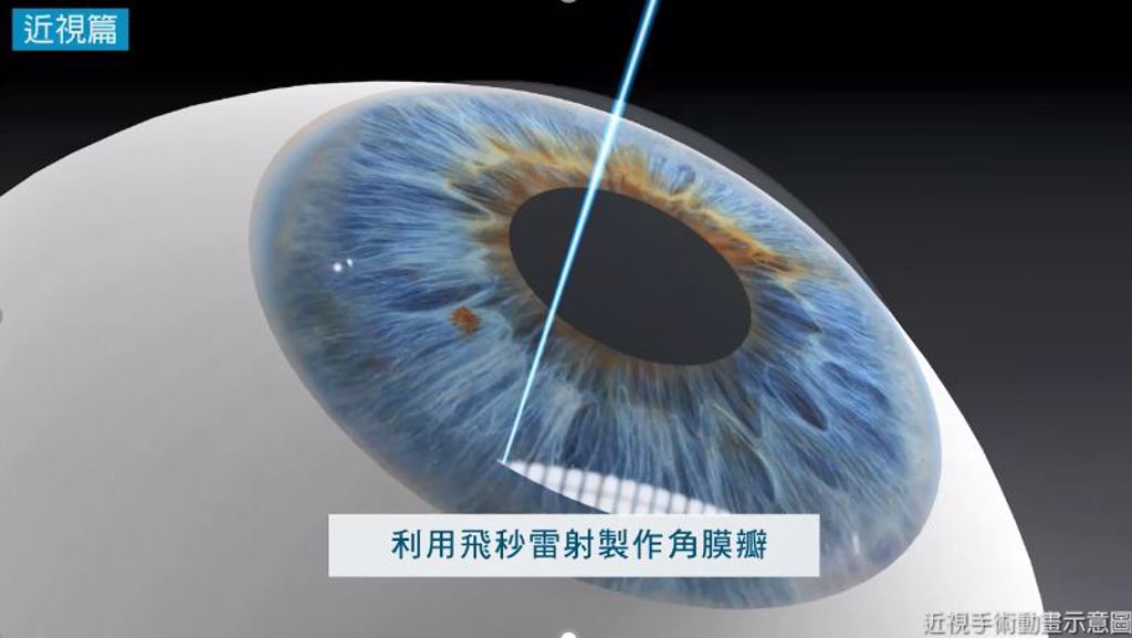 近視手術動畫示意圖。圖/大學眼科提供。