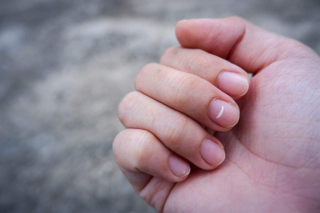 指甲為何有白點？異常訊息透露的身體求救訊號。(示意圖/Shutterstock)