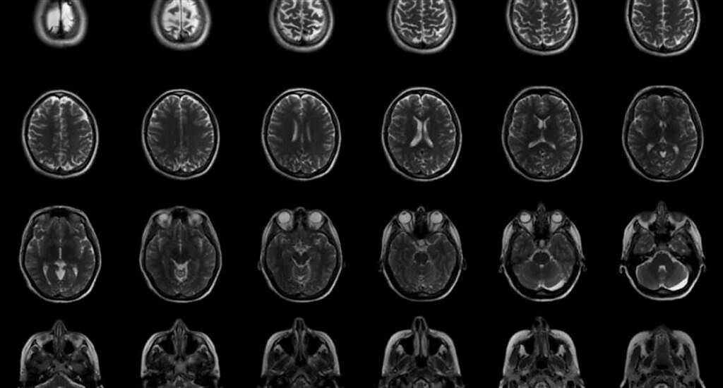 染過COVID-19的人大腦灰質會顯著減少！增加罹患阿茲海默症機率（圖／明日科學）