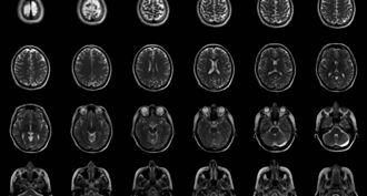 染過COVID-19的人大腦灰質會顯著減少！增加罹患阿茲海默症機率