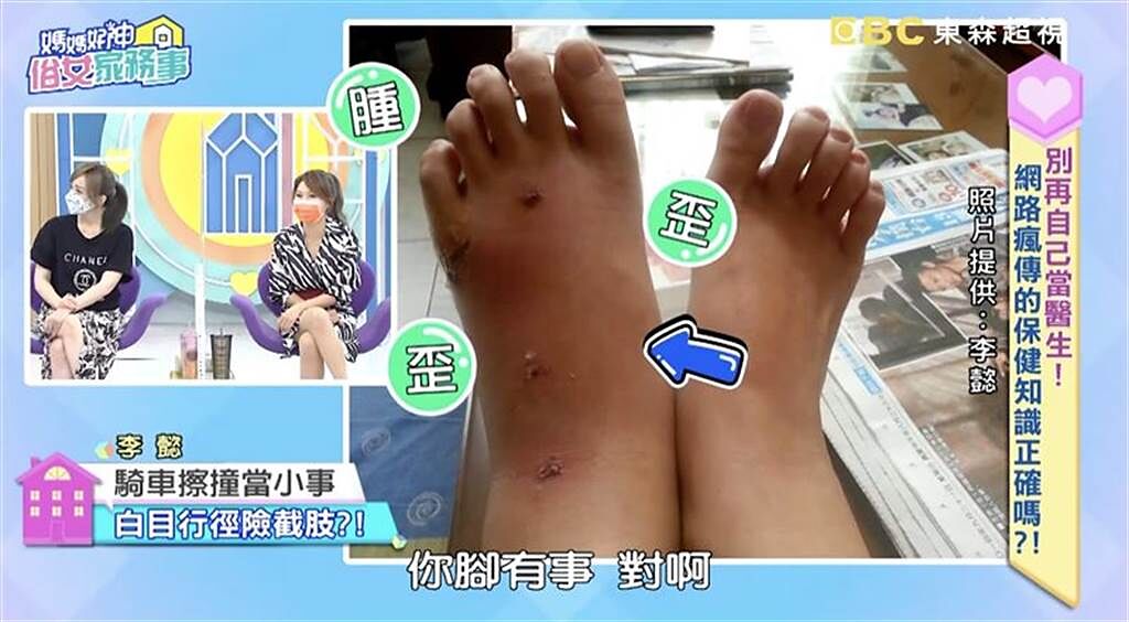李懿的左腳明顯腫起來。（圖／翻攝自媽媽好神之俗女家務事YouTube）