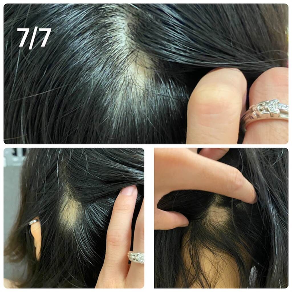 日本一名女子接種莫德納疫苗後開始嚴重掉髮。（圖／翻攝自ameblo）