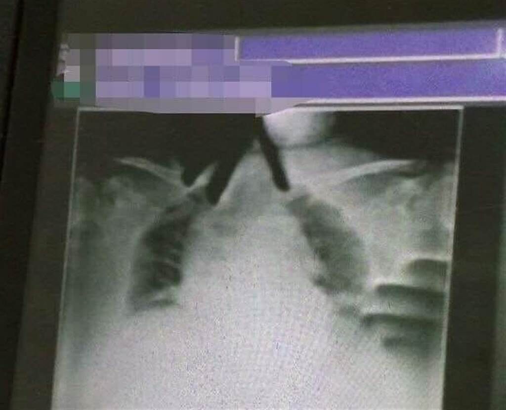 婦人突然喘不過氣，緊急照X光片竟然有一雙手緊掐著婦人，畫面詭異。（翻攝自臉書靈異公社）