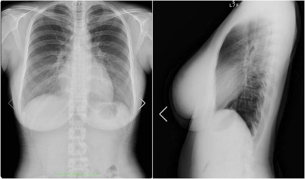 天木純曬X光片證明自己胸部不是假的。（圖／翻攝自IG）