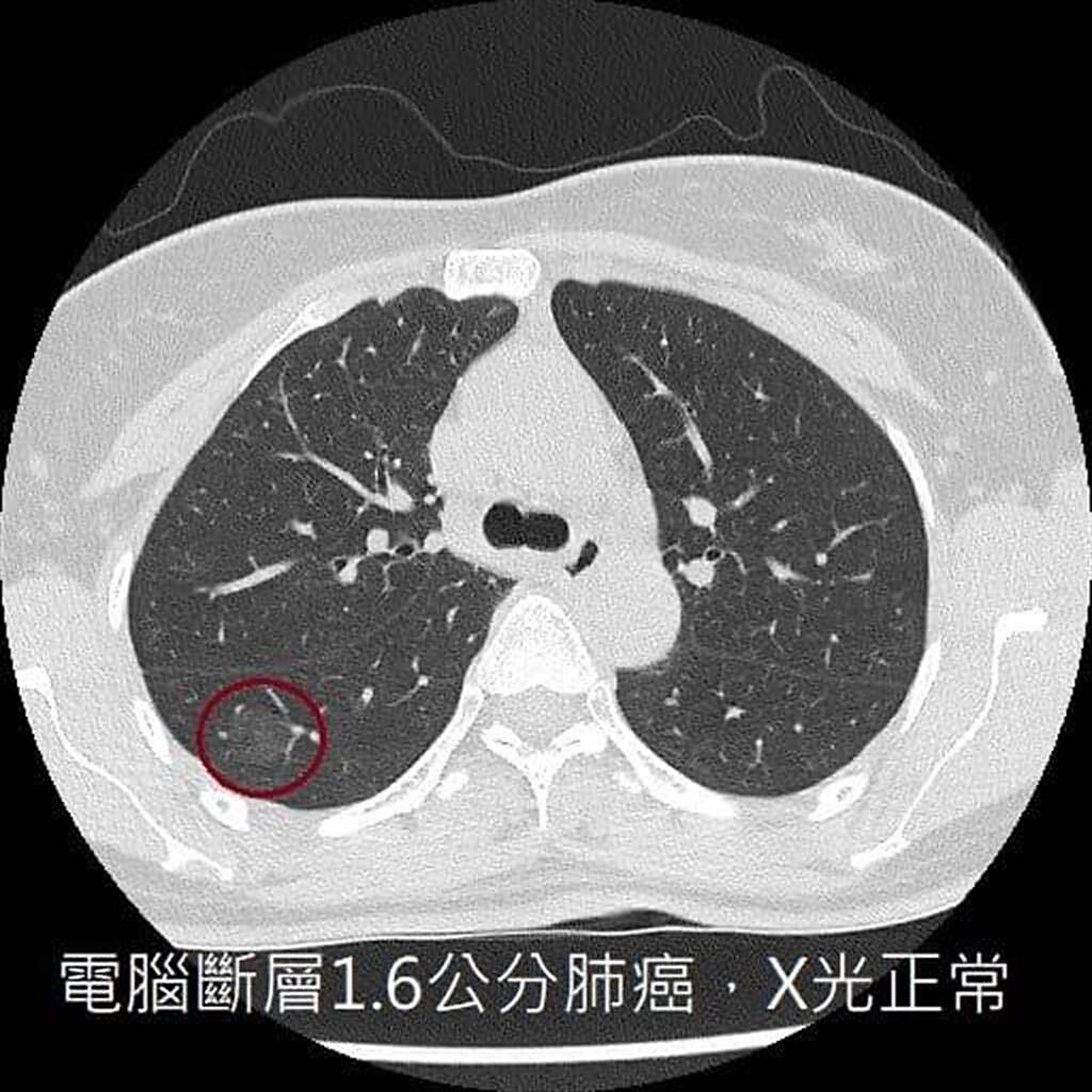 醫師分享病患狀況，提醒X光正常不等於沒有肺癌。（翻攝蘇一峰臉書）