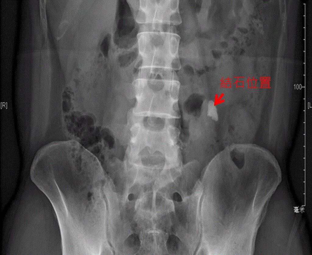 圖為患者左邊輸尿管已被2公分大的結石塞住，腎臟呈現中度水腫。(圖/書田診所提供)