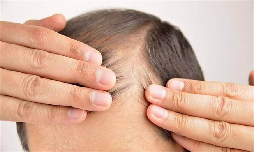連續4天吃太油就會禿頭？　專家：3種關鍵營養影響頭髮健康。(示意圖/Shutterstock)