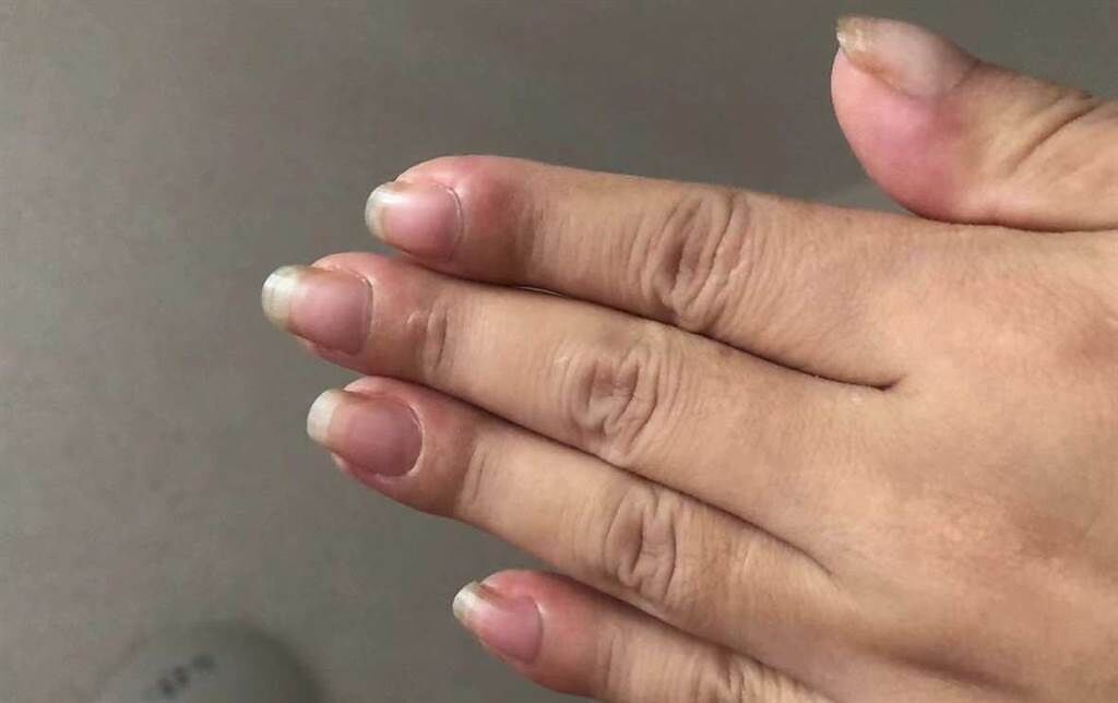 一名女子的10根手指腫成「蘿蔔」，就醫檢查竟是得了肺癌。(翻攝自《深圳新聞網》)
