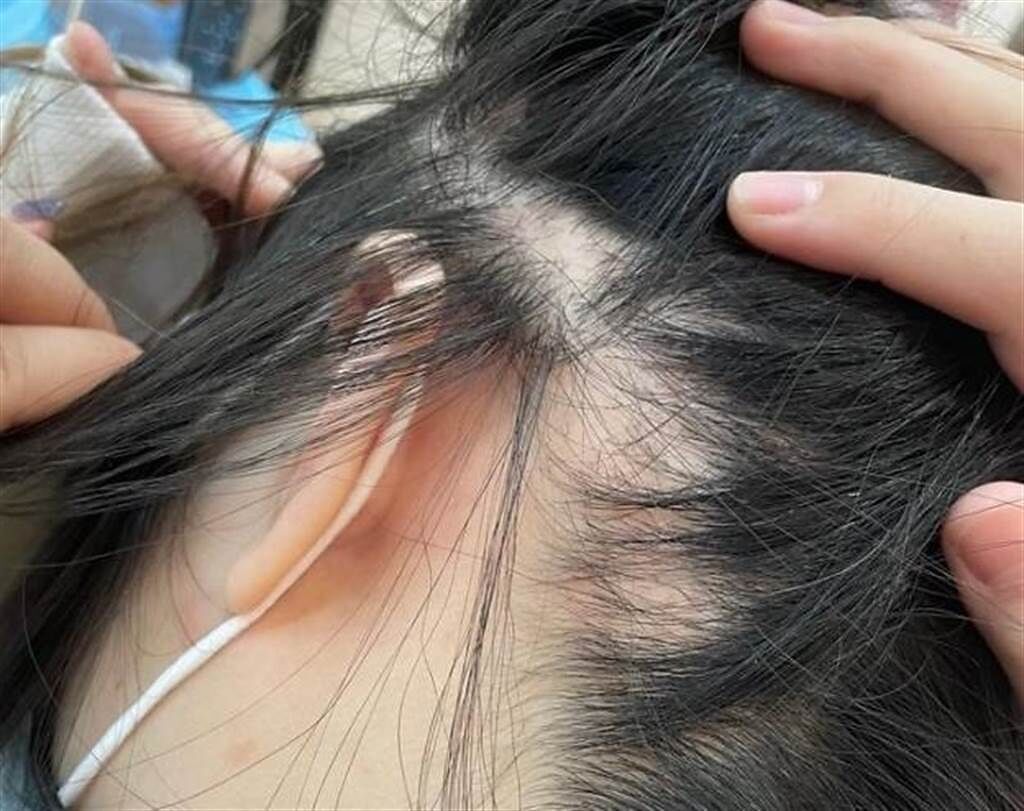 女網友除了頭頂有塊顯而易見的禿頭外，側邊的頭髮感覺越來越稀疏。（圖／翻攝自Dcard）