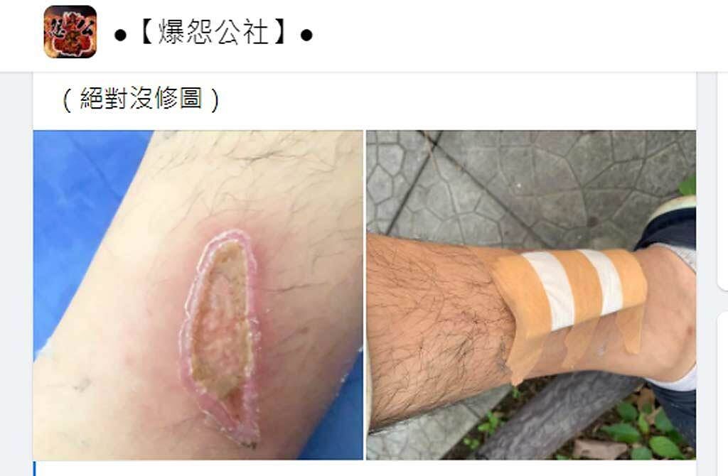 網友小腿被機車排氣管燙出一個激似台灣的傷口。（翻攝臉書私密社團《●【爆怨公社】●》）