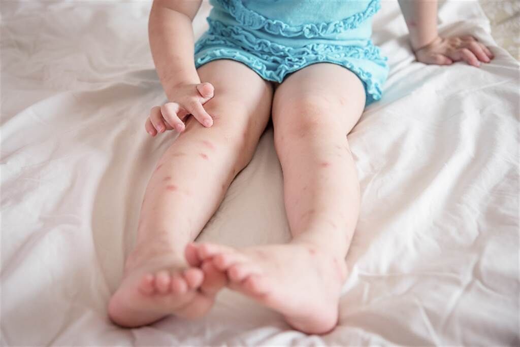 快看看孩子的腿！若有不明紅疹、水腫要快就診，若是過敏性紫斑症延遲就醫恐傷腎，才感冒過的孩子家長要更警覺。(示意圖/Shutterstock)
