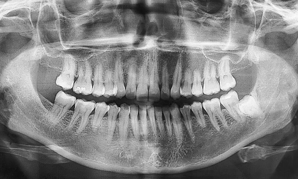 菲律賓一名男童9歲時，嘴裡長滿300顆牙齒，導致他說話與吃飯都受到影響。(示意圖/達志影像)