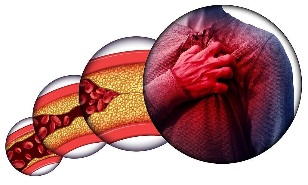 有效預防動脈粥狀硬化 醫曝：這指數控制好 就是最強保護。(示意圖/Shutterstock)
