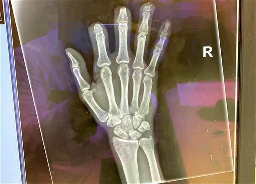 中市一名男子於上班時發生意外右手手指截肢，未料卻被要求歸還職災工傷期間的薪資賠償35萬元。(圖／爆料公社)