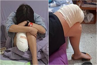 職災後103天 截肢女孩突發文「想念我的右腿」網心疼