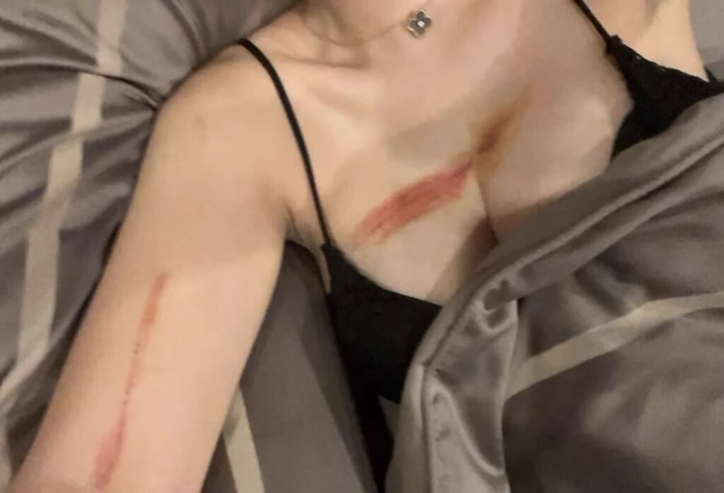 女子遭到黑衣人毆打，雪白的胸前留下長條狀的紅色擦傷。（翻攝臉書「อยากดังเดี๋ยวจัดให้ รีเทริน์ part 3」）