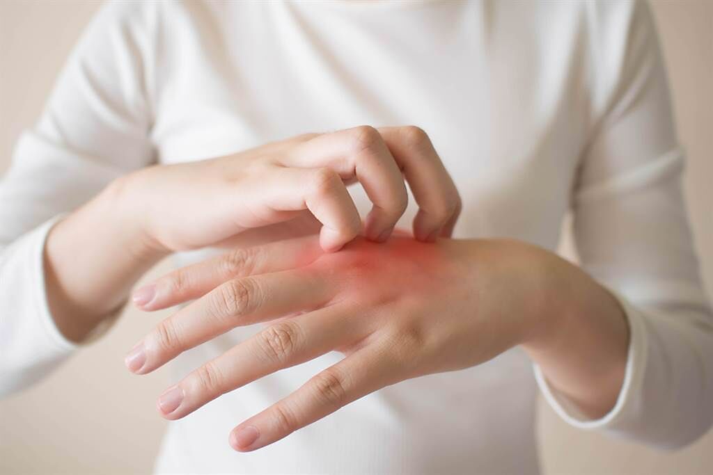 乾癬症狀越顧越糟糕？ 恐是錯失治療3大關鍵。(示意圖/Shutterstock)