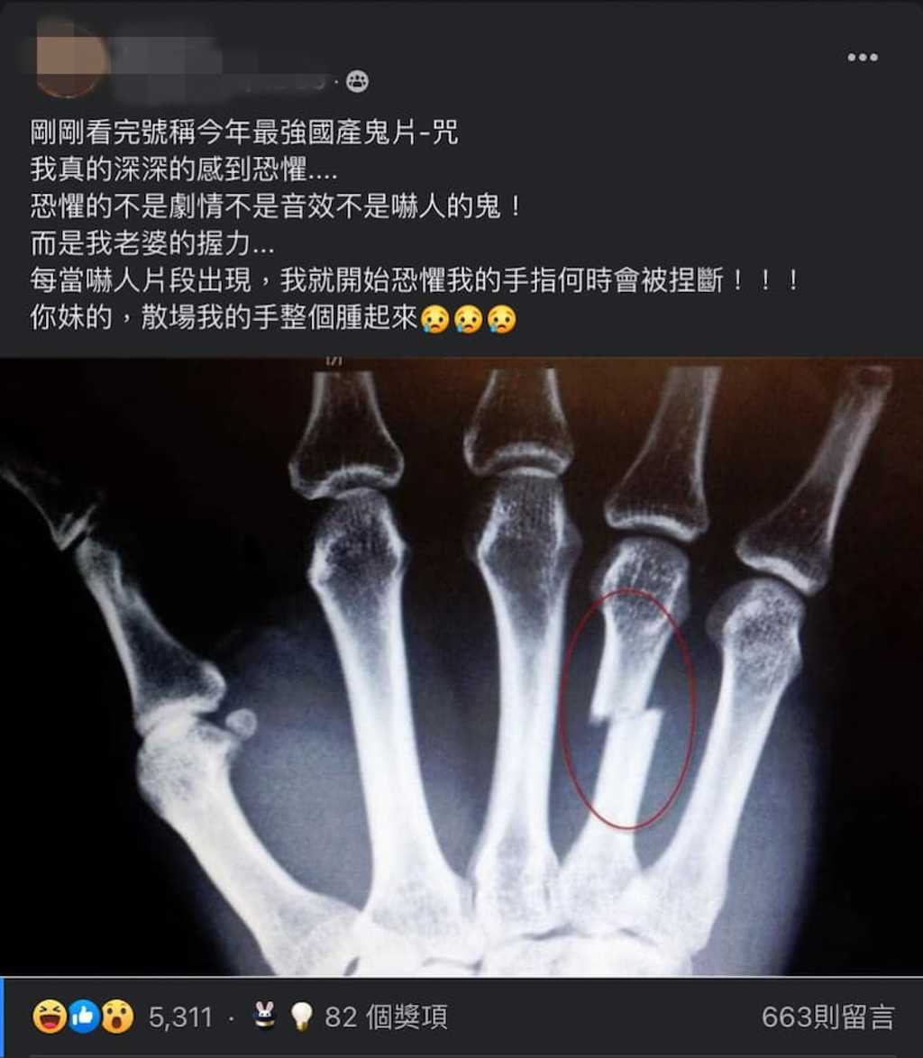 網友曬出被老婆捏斷的手指。(圖/翻攝自「爆怨公社」)
