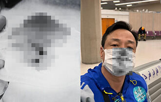 54歲王喜入境台灣「鼻子被捅爆血」PCR還呈陽性