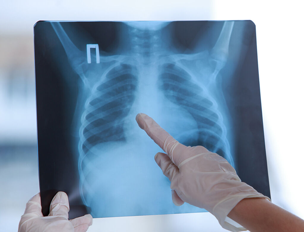 照X光胸部整片白，醫一看大呼晚期了。（圖／shutterstock）