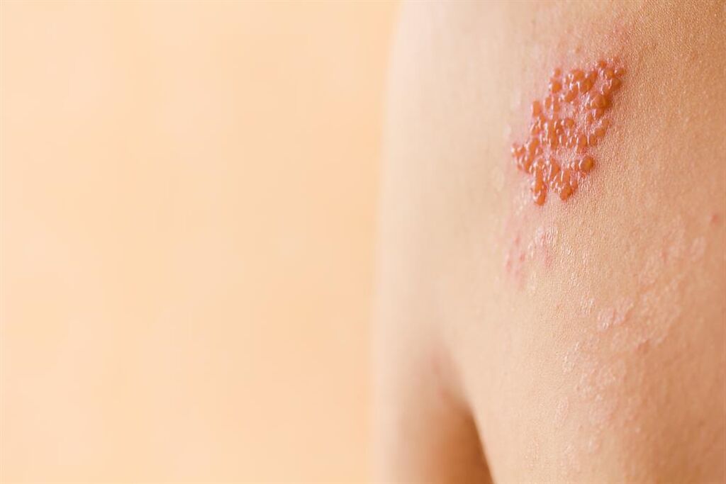 醫列該警覺的7個小毛病：會痛就完了 帶狀皰疹恐發作。(示意圖/Shutterstock)