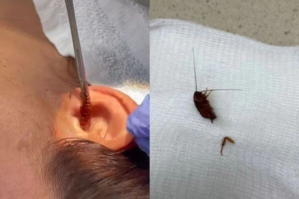 醫生從女子的耳朵夾出蟑螂。(圖/翻攝自TikTok@keenanslifeTikTok)
