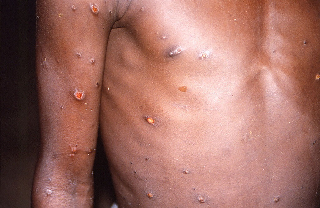 感染猴痘（monkeypox）病毒後患者會出現疹子，並且蔓延全身。（圖／路透社、美國CDC）