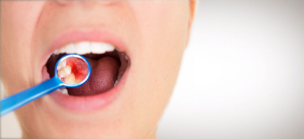 牙垢藏在最後面？好意外！牙醫曝：其實這3處牙結石最多。（示意圖／Shutterstock)