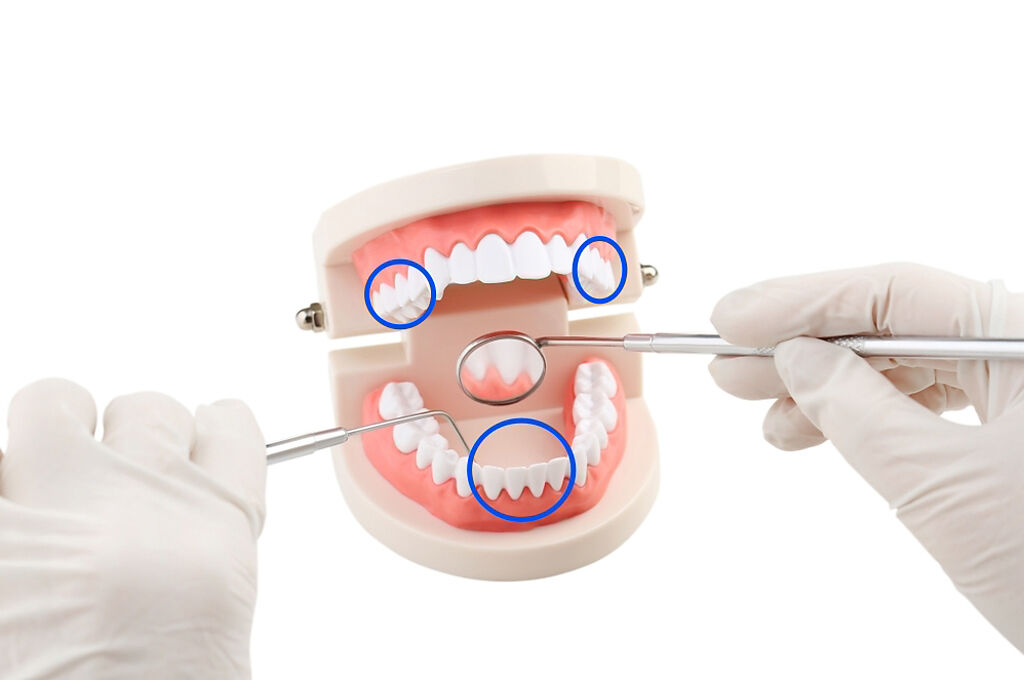 牙垢最多的部位(藍色圓框處)，分別是前排下方牙齒內側與兩頰腮腺處大小臼齒間。(資料來源/牙醫師炫晨 示意圖/Shutterstock)