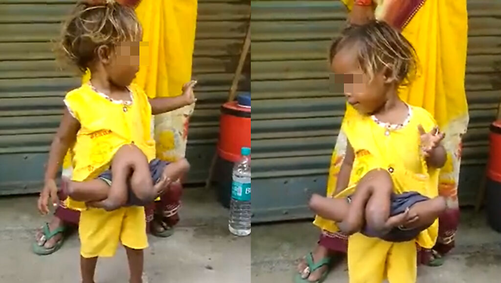印度2歲女童擁4手4腳，因此被外界封為「蜘蛛女孩」。（圖／翻攝自Twitter）