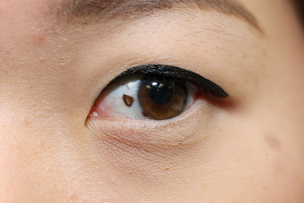 眼白長痣是癌症嗎？醫：4類型要留意 若惡性恐致盲。(示意圖/Shutterstock)
