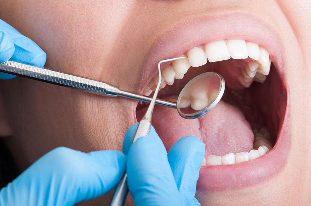 牙醫師柯佩伶提醒，5類人洗牙前須先服用預防性抗生素。（示意圖／ShutterstocK）