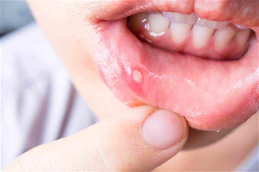 一名50多歲大哥嘴破半年都未好轉，經檢查發現是口腔癌第三期。（示意圖／Shutterstock）