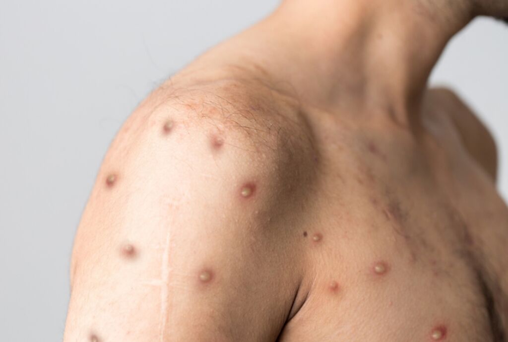 猴痘快速蔓延，已引起世界衛生組織憂心。（示意圖／Shutterstock）