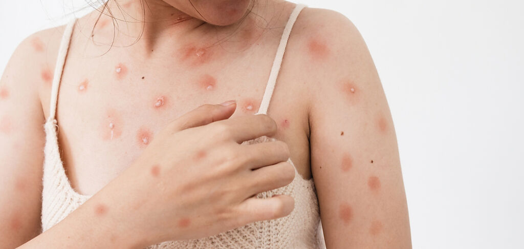 確診猴痘後會出現皮膚病灶如斑疹、丘疹、水泡、膿疱，讓民眾不免恐慌。（示意圖／Shutterstock）