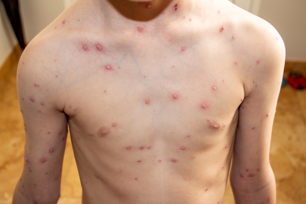 猴痘自5月開始在歐洲和北美陸續爆發人傳人流行。（示意圖／Shutterstock）