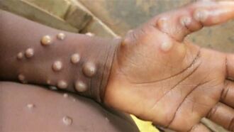 猴痘致死率最高10％ 醫揭5QA懶人包